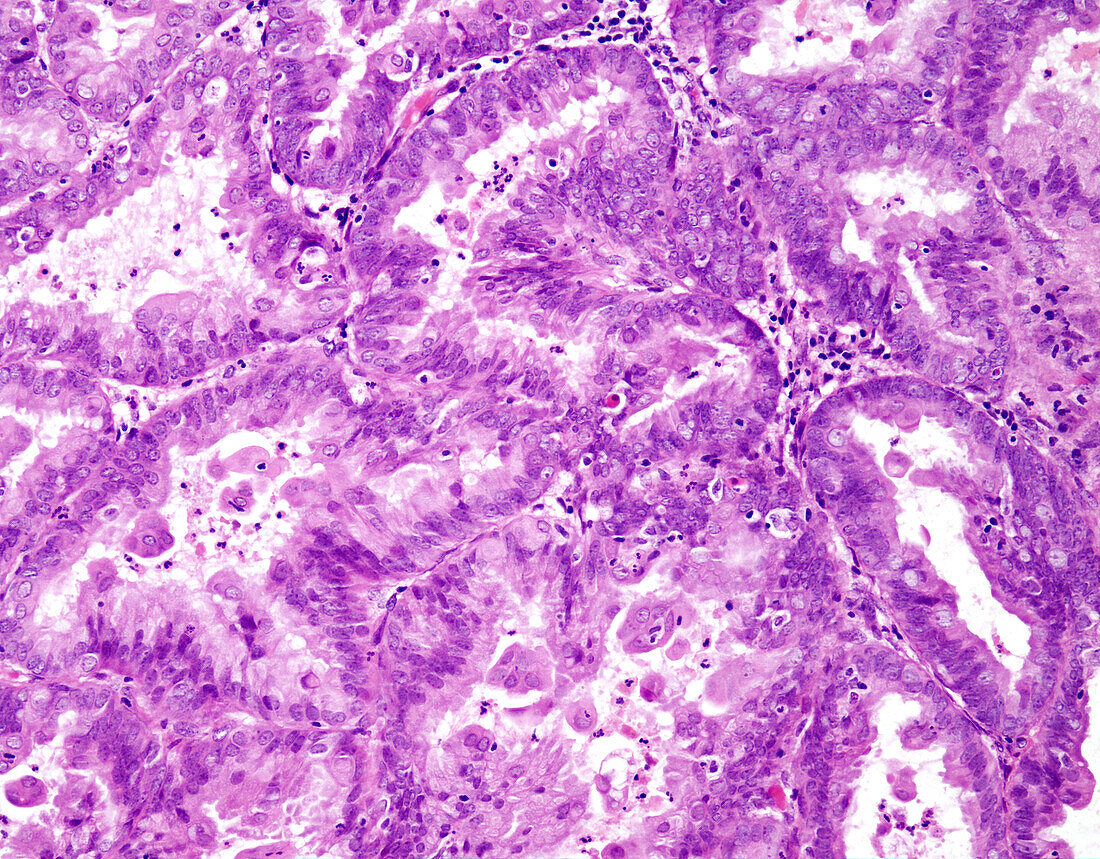 endometrioid-carcinoma-grade-1-light-acheter-une-photo-13613290