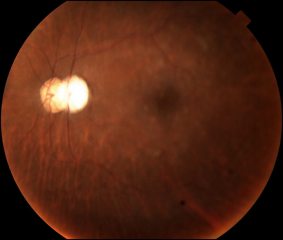 Intraocular lens subluxation, fundoscopy