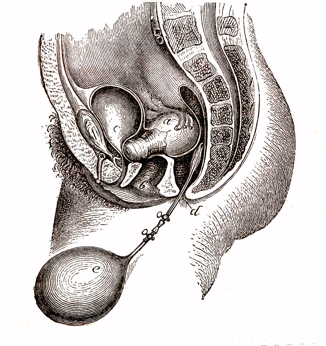 Uterus retroverted towards the spine, illustration