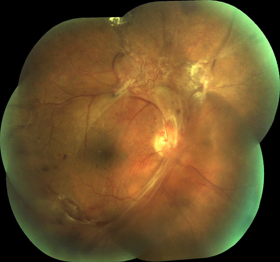 Retina damage from diabetes, fundoscopy