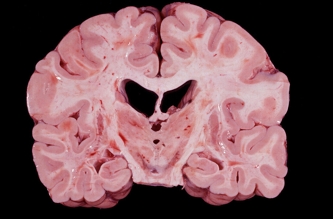 Human brain, gross specimen