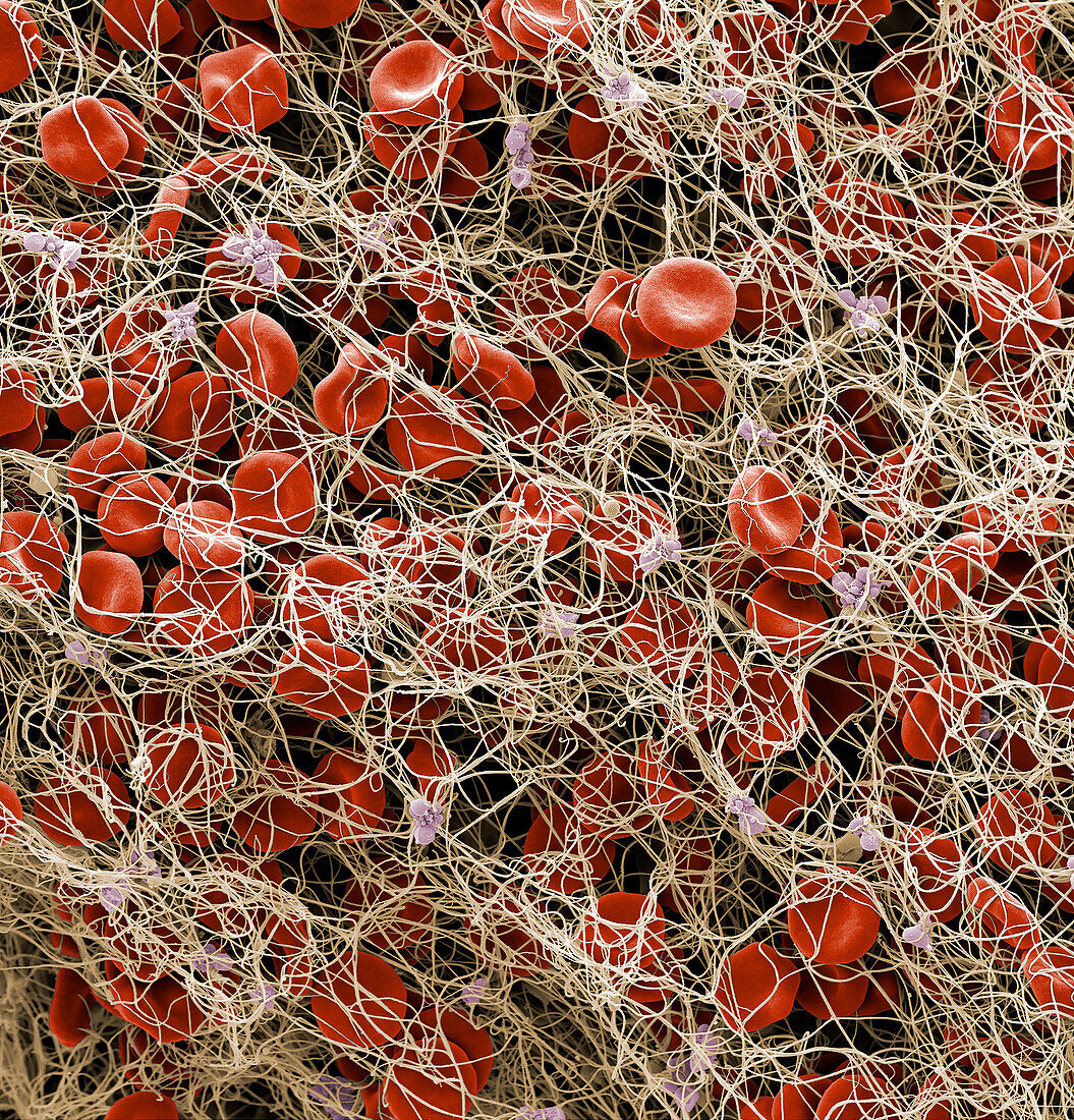 Red blood cells and platelets in blood clot, SEM