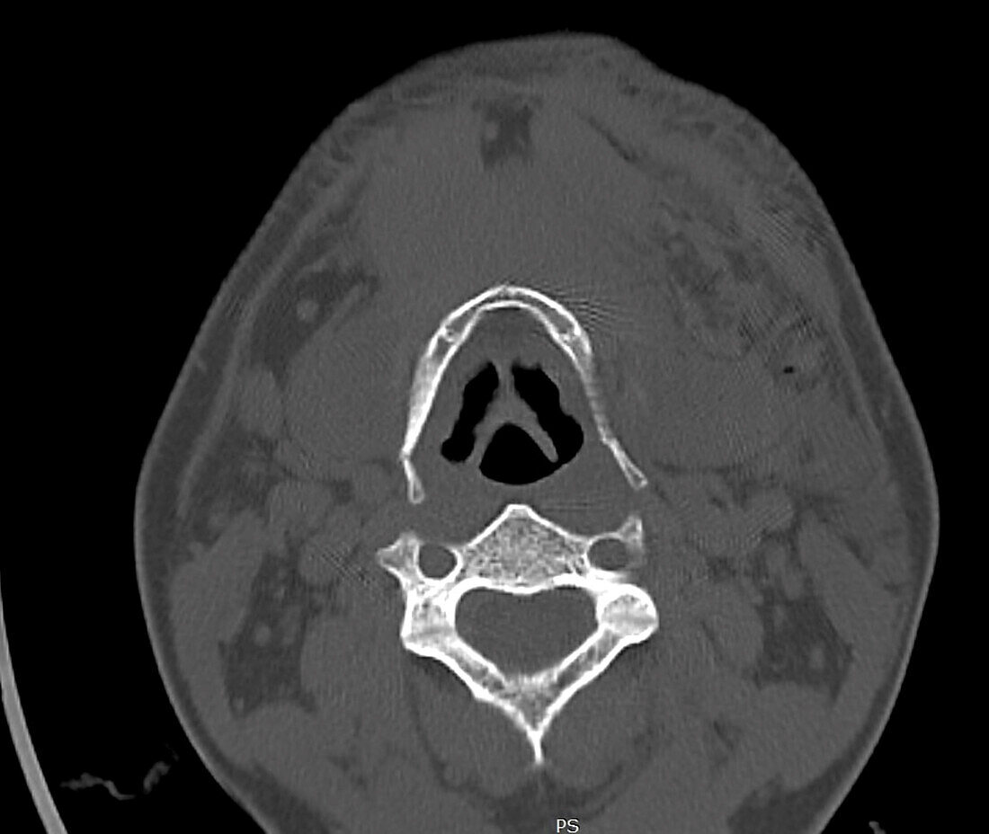 Fractured hyoid bone, CT scan