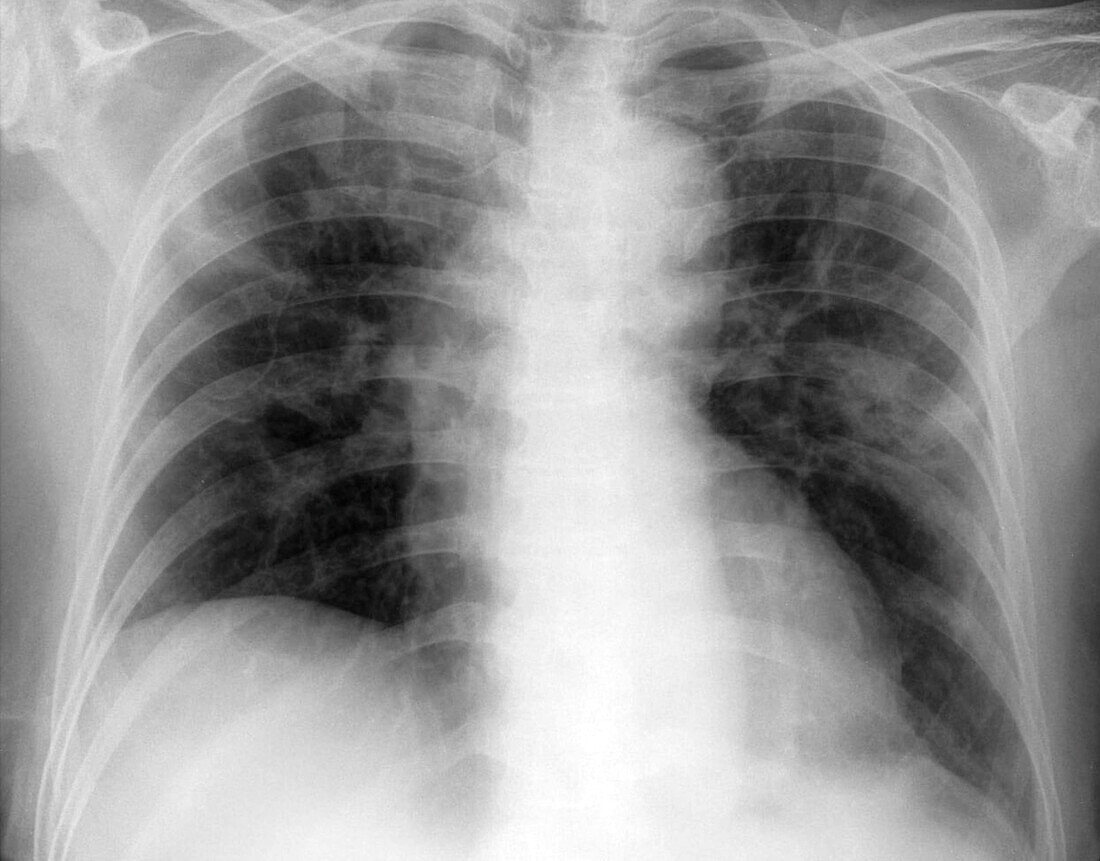 Covid-19 pneumonia, X-ray