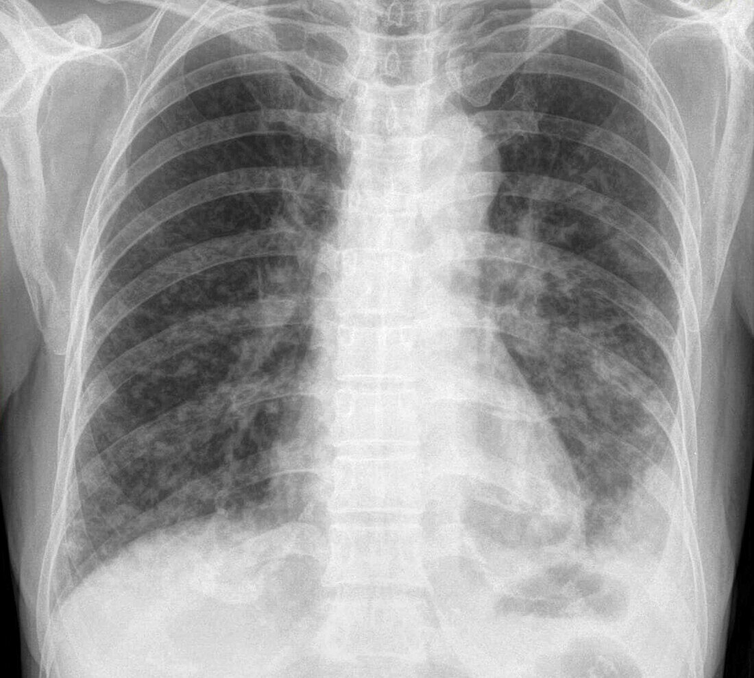 Miliary nodules, X-ray