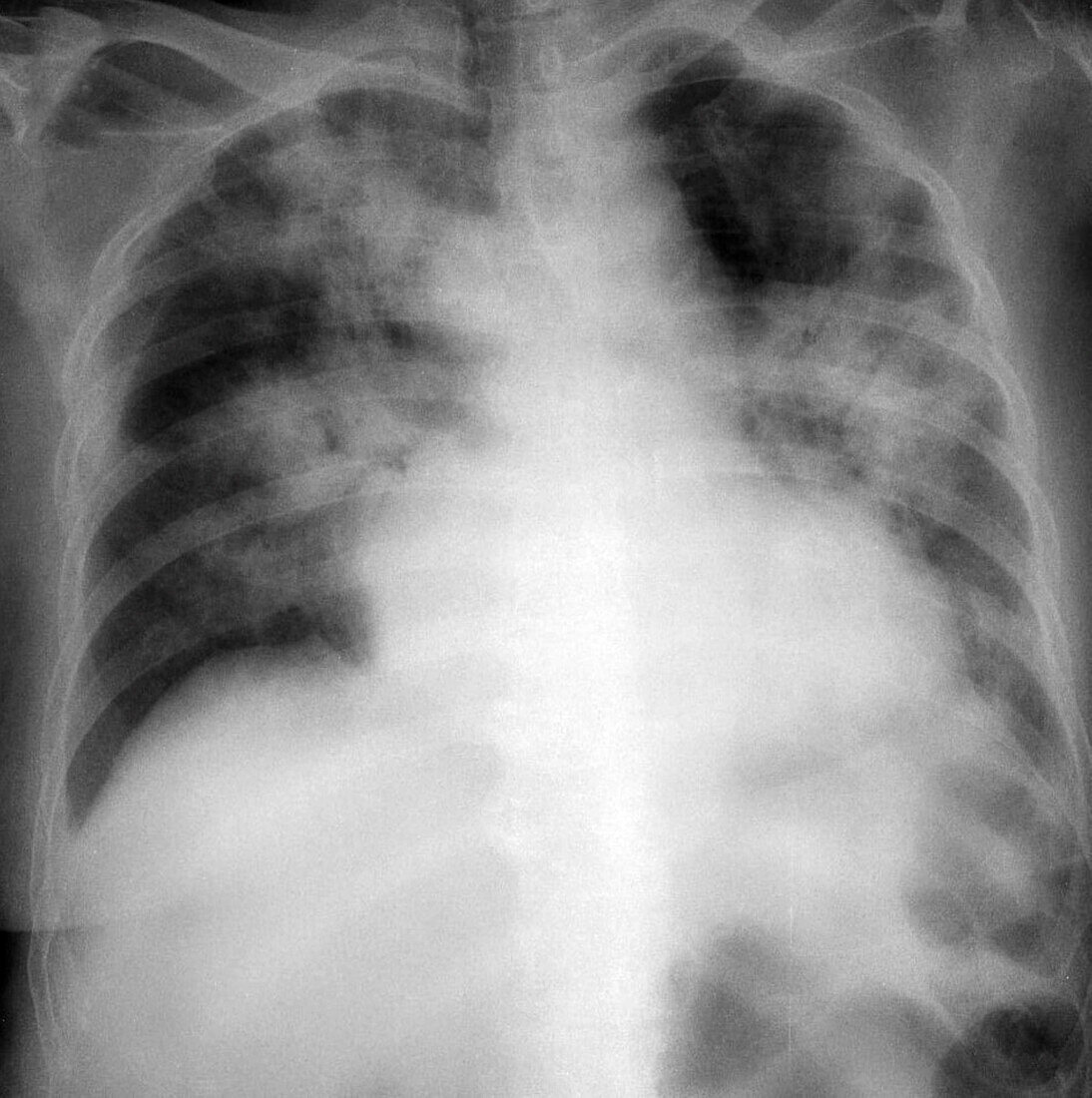 Chest X-ray of covid 19 pneumonia