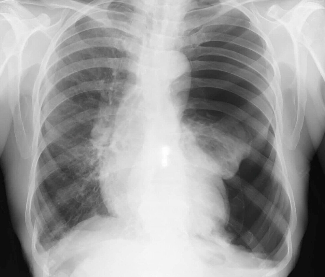 Pneumothorax, X-ray