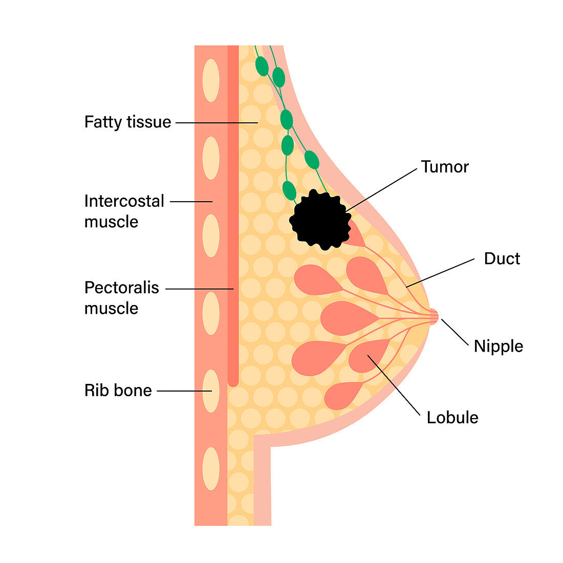 Female breast cancer, illustration