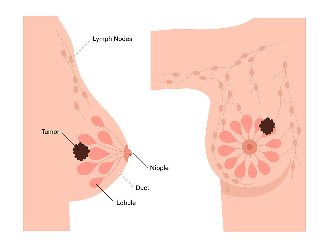 Female breast cancer, illustration