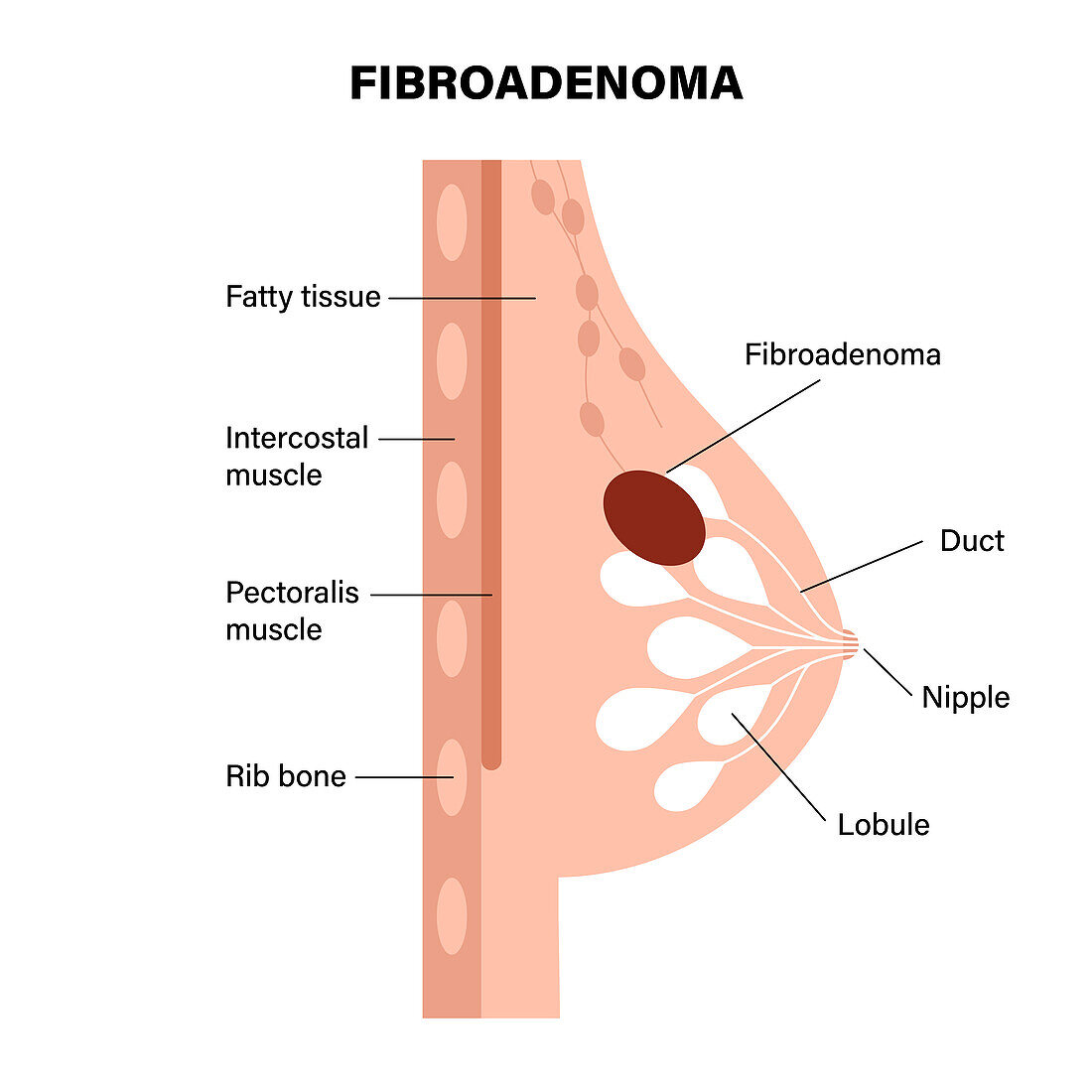 Fibroadenoma, illustration