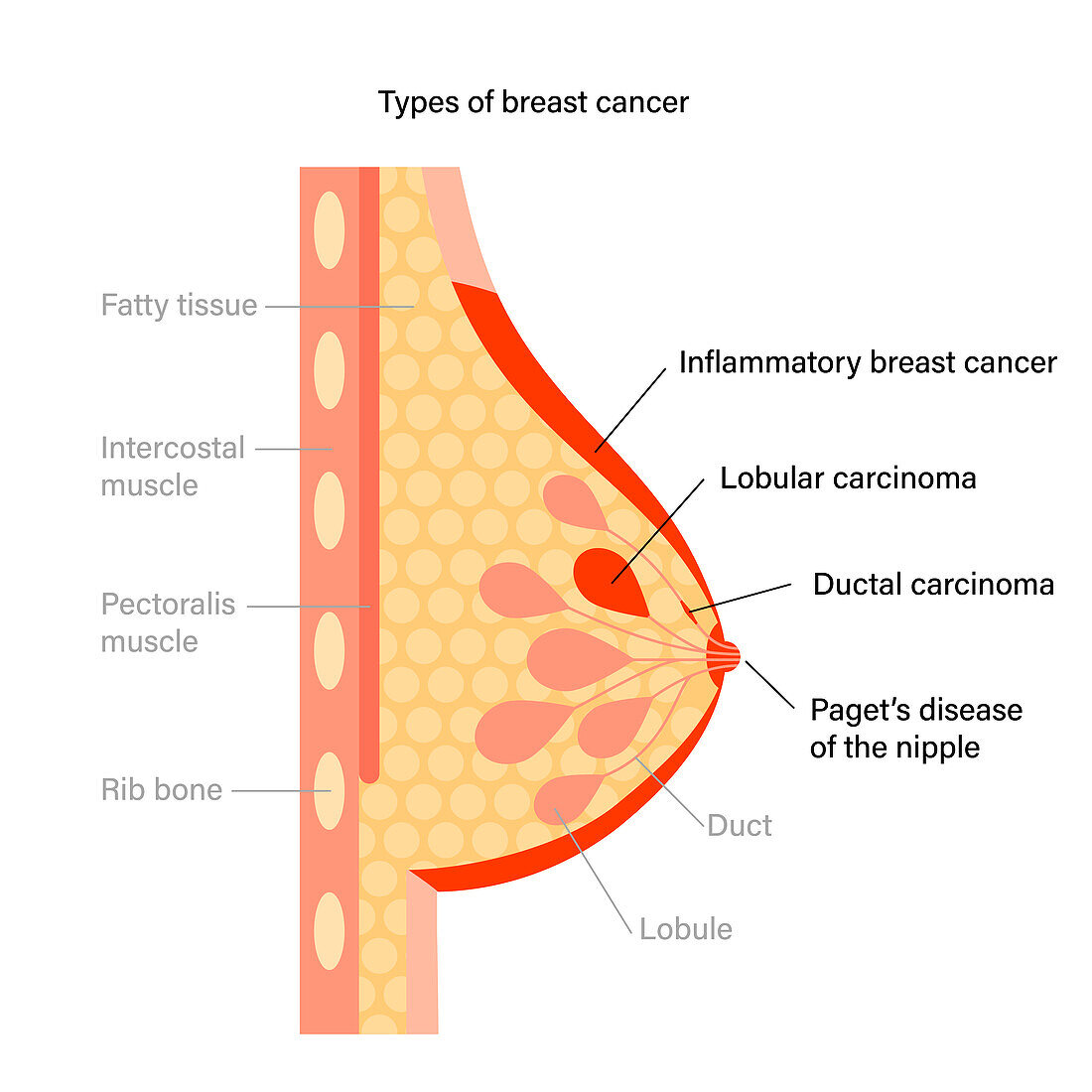 Types of breast cancer, illustration