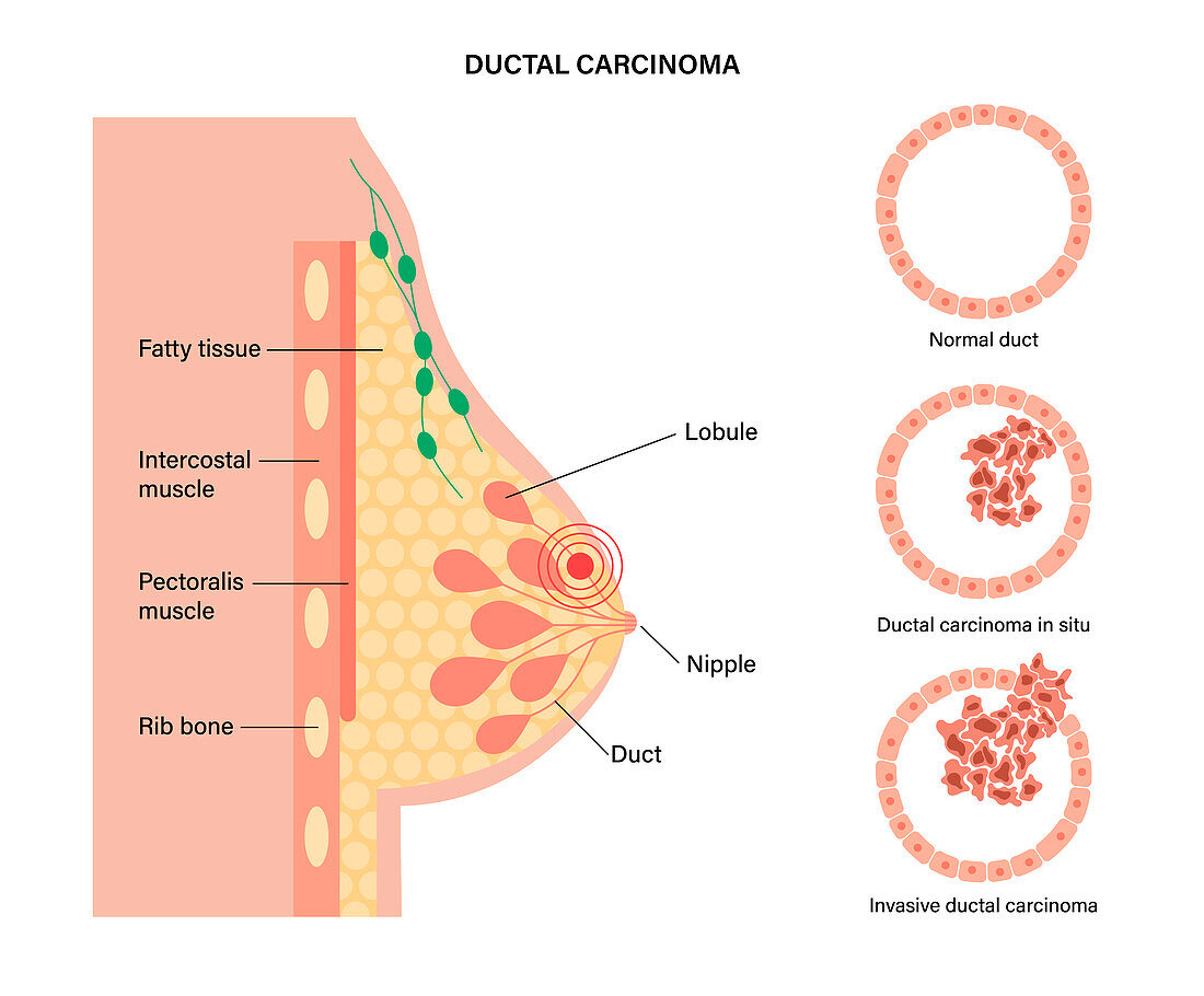 Invasive ductal carcinoma, illustration