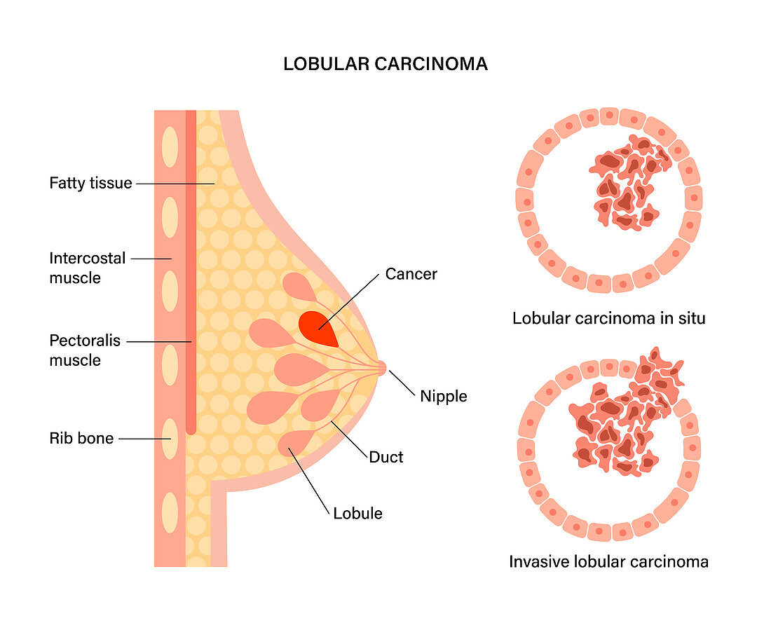 Invasive lobular and carcinoma in situ, illustration