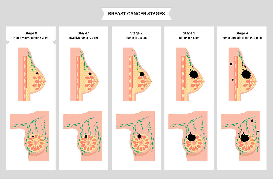 Breast cancer stages, illustration