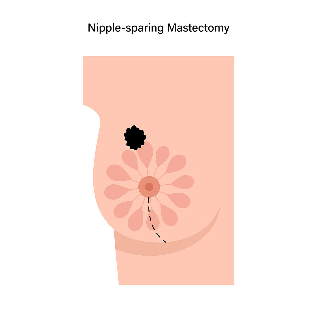 Female nipple sparing mastectomy, illustration