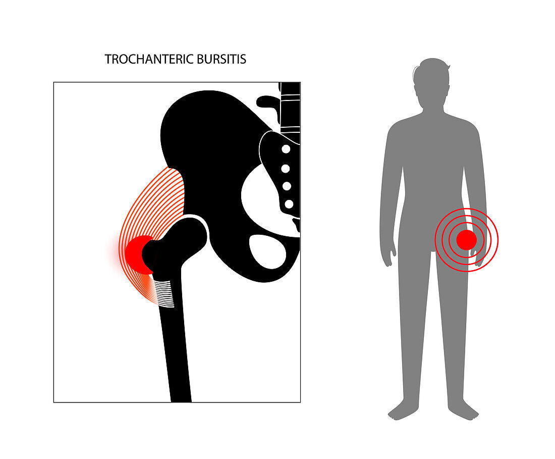 Hip bursitis, conceptual illustration
