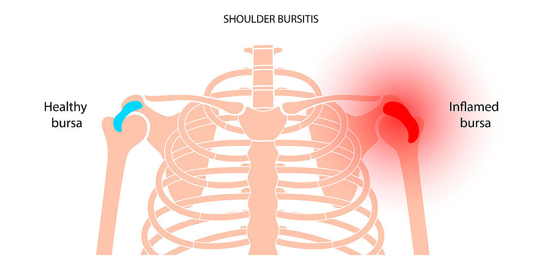 Shoulder bursitis, conceptual illustration