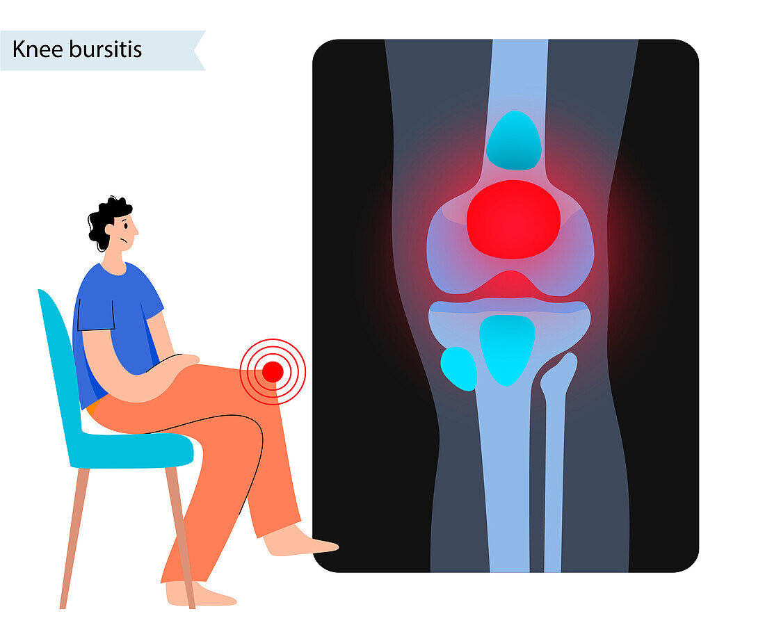 Knee bursitis, conceptual illustration