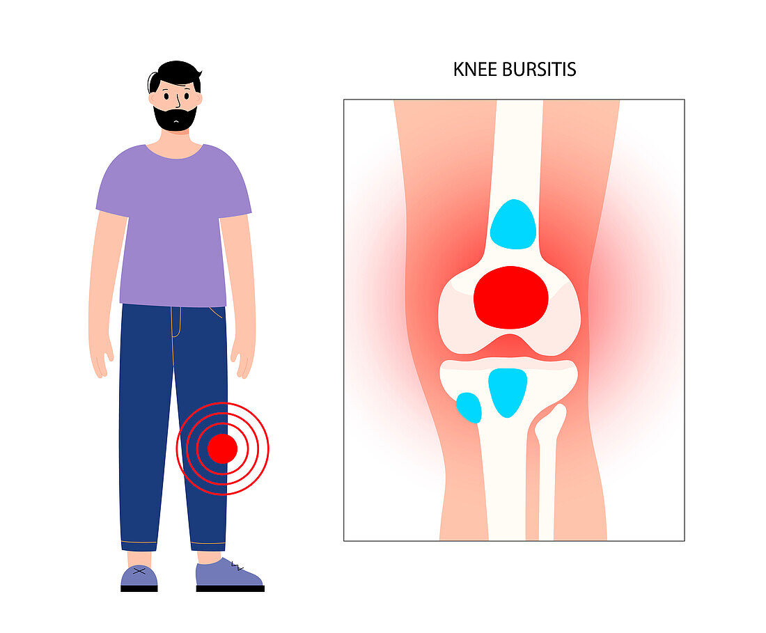 Knee bursitis, conceptual illustration