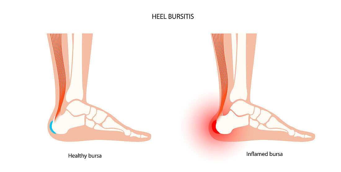 Heel bursitis, conceptual illustration