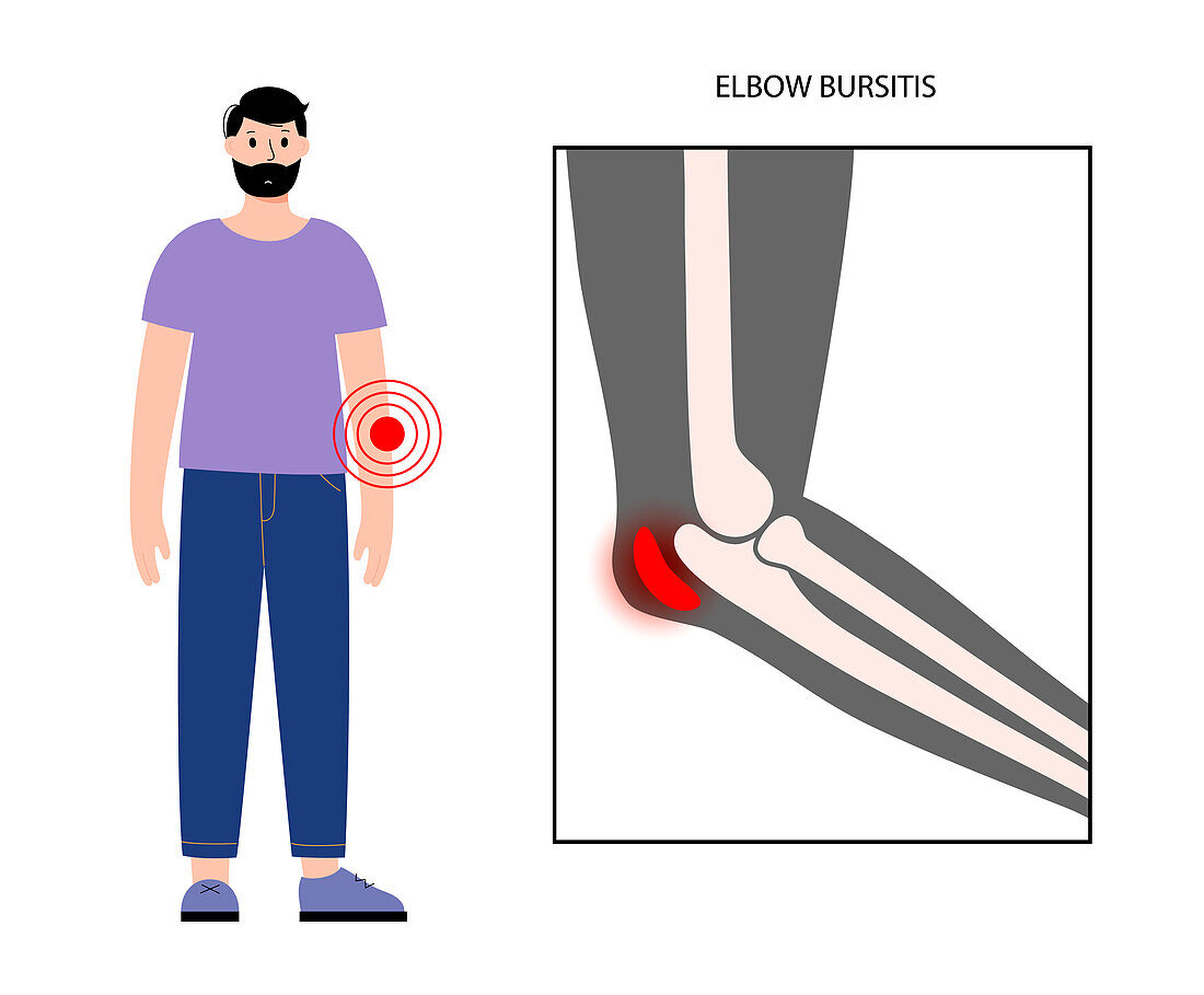 Elbow bursitis, illustration