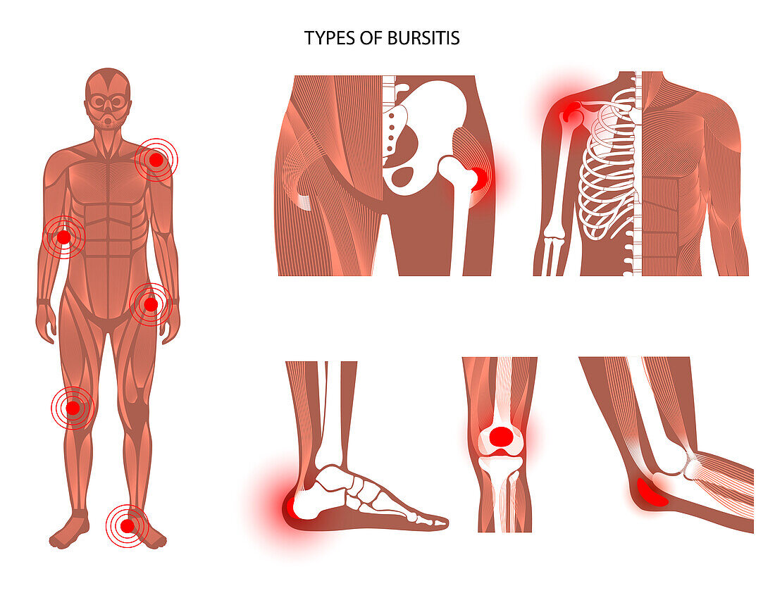 Types of bursitis, illustration