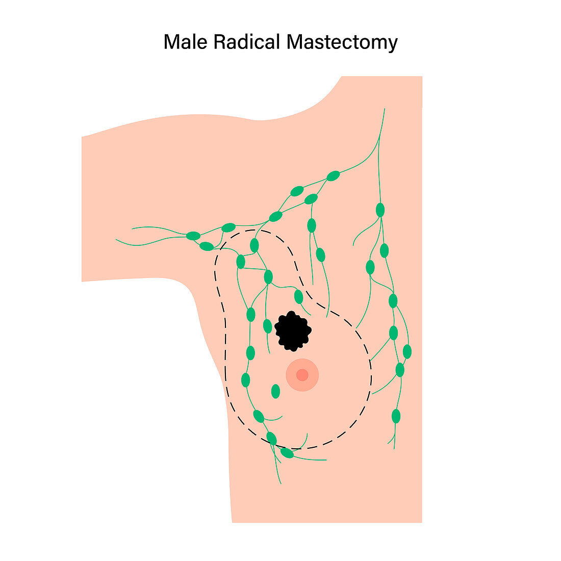 Male radical mastectomy, illustration