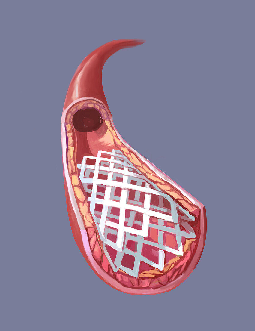 Clogged artery stent, illustration