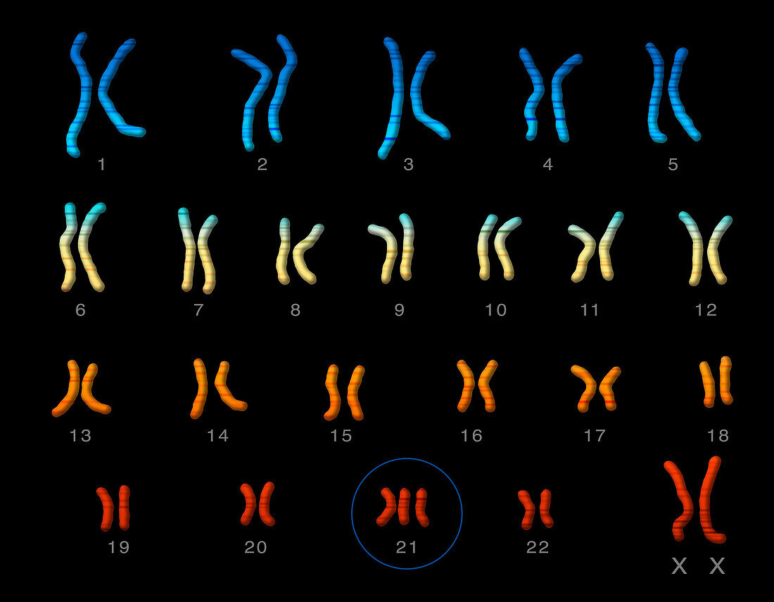 Down syndrome karyotype, illustration