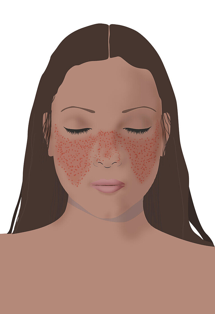 Lupus rash on woman's face, illustration