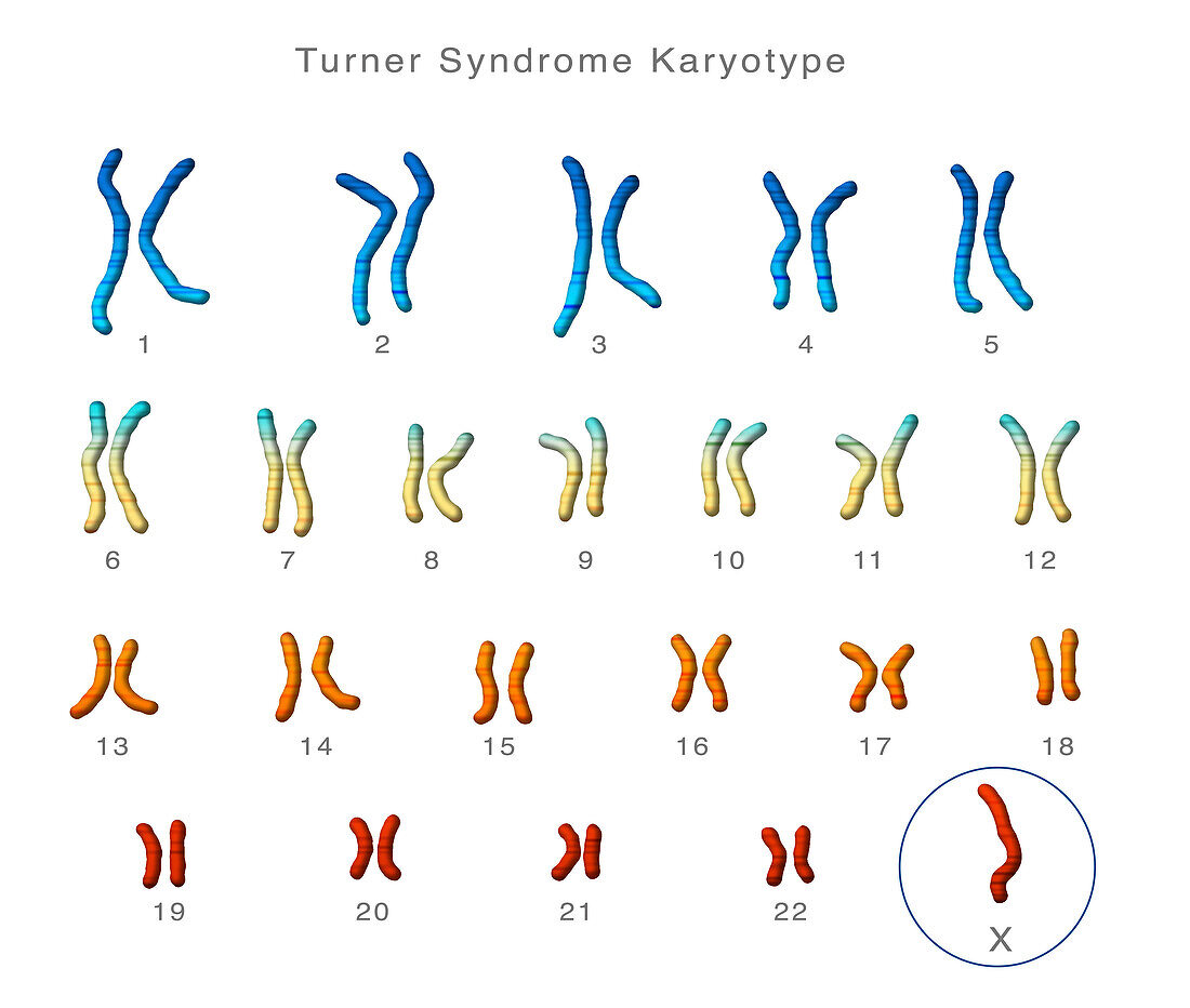 Turner's syndrome karyotype, illustration