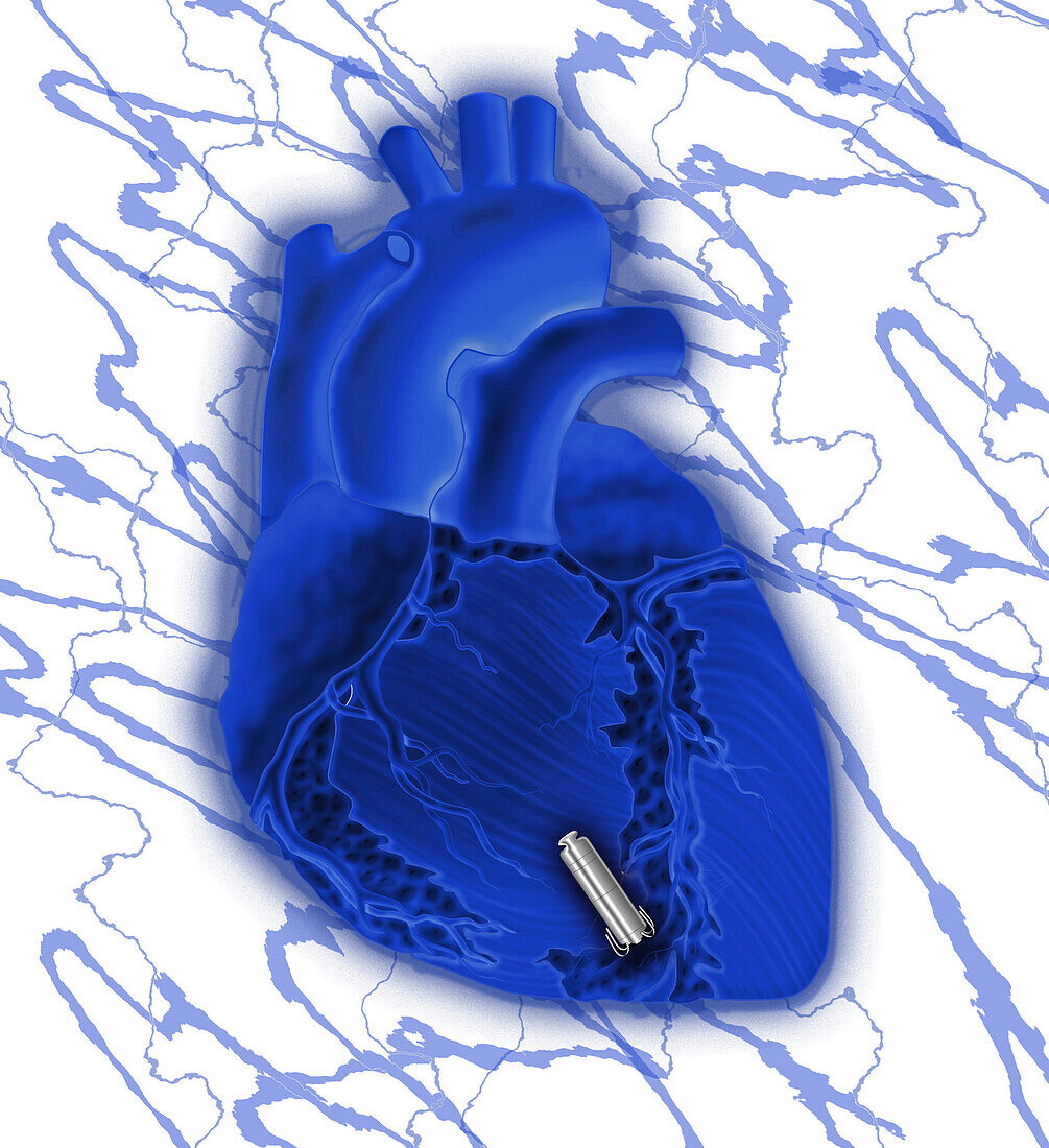 Leadless pacemaker and heart, illustration