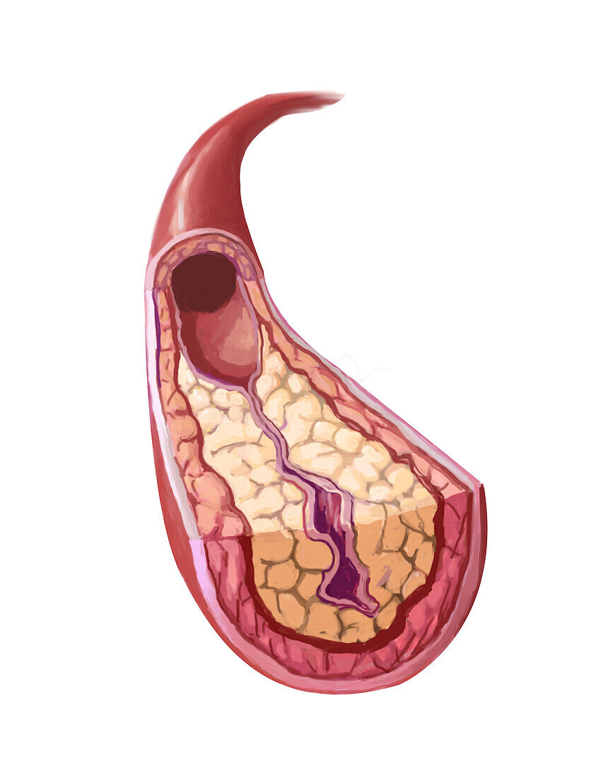 Clogged artery, illustration