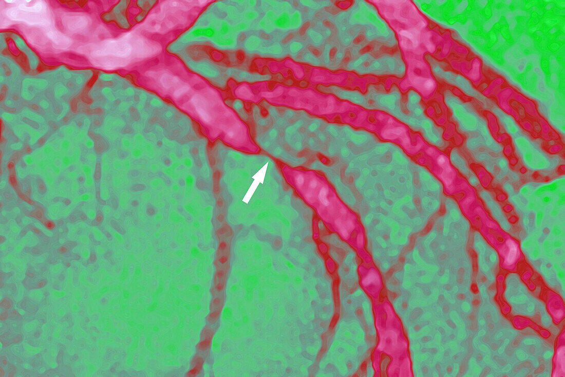 Stenosis due to myocardial infarction, angiography