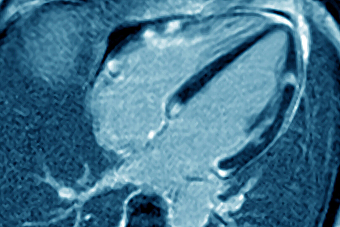 Cardiac sarcoidosis, MRI scan