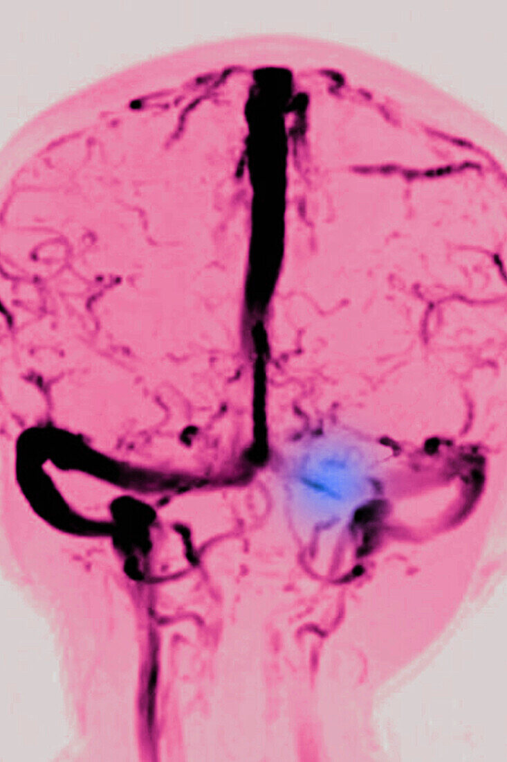 Cerebral venous thrombosis, MRA scan
