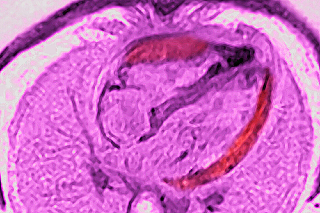 Myocarditis, MRI scan