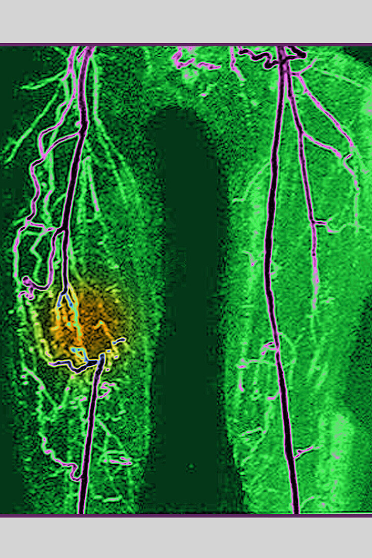 Thrombosis of iliac artery, MRA scan