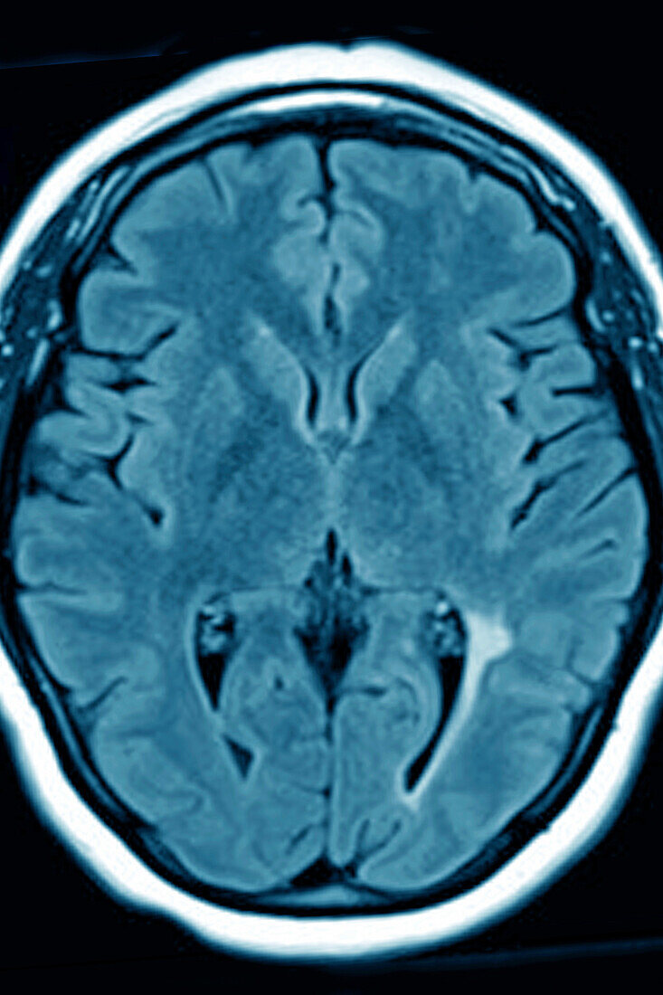Cerebrovascular thrombosis, MRI scan