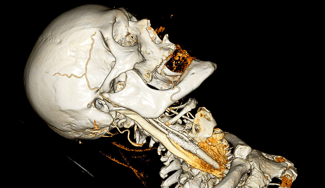 Arterial stent, 3D CT scan