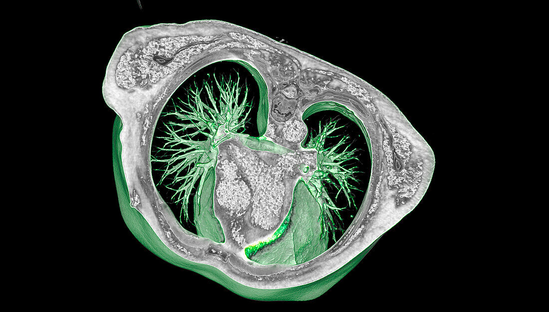 Healthy lungs and mediastinum, 3D CT scan