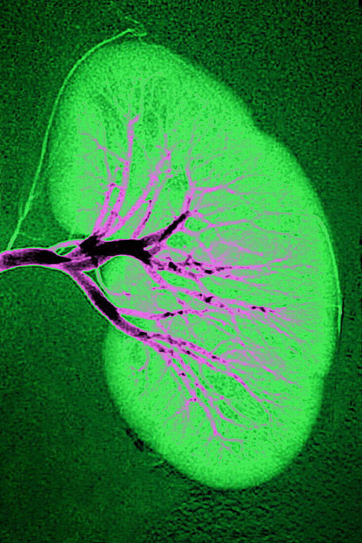 Left renal artery, angiography