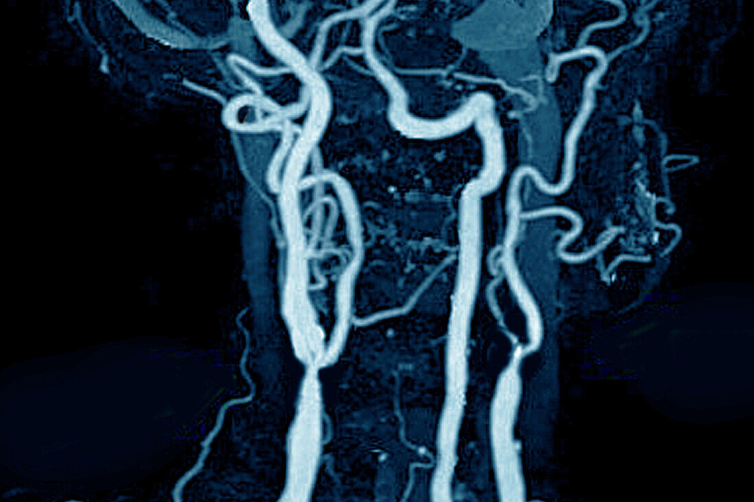 Carotid stenosis, angiography