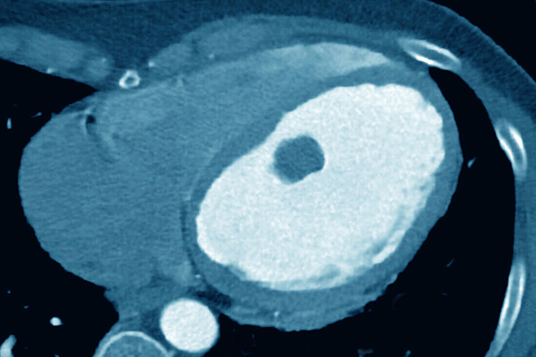 Intracardiac thrombus, CT scan