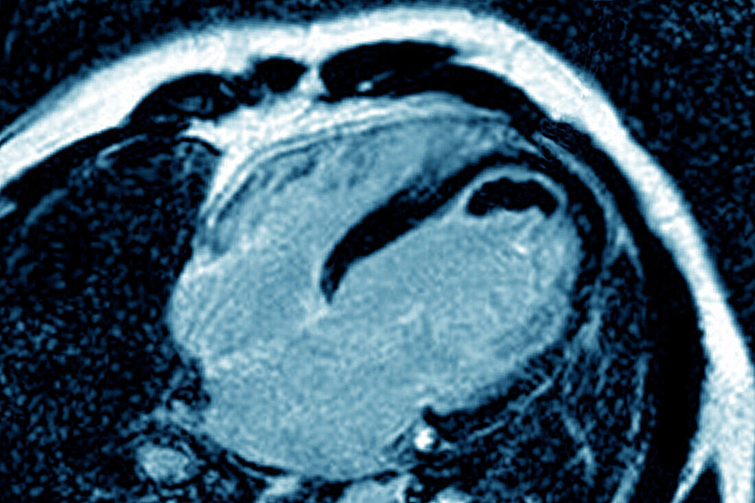 Cardiac thrombus, MRI scan