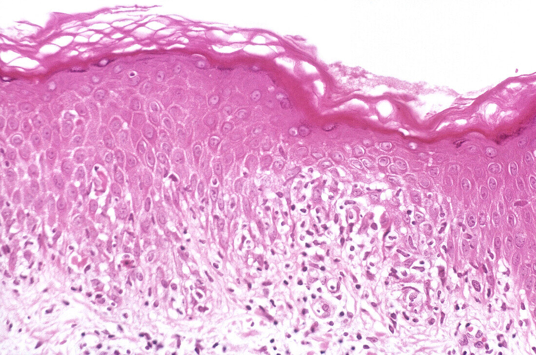 Staphylococcal scalded skin syndrome, light micrograph
