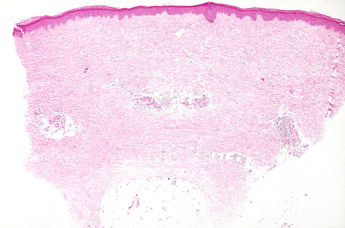 Scleroderma, light micrograph