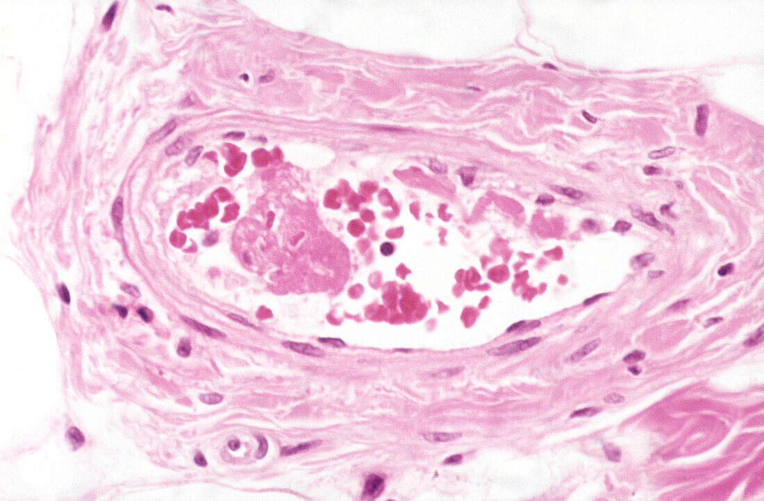 Meningococcal septicaemia, light micrograph