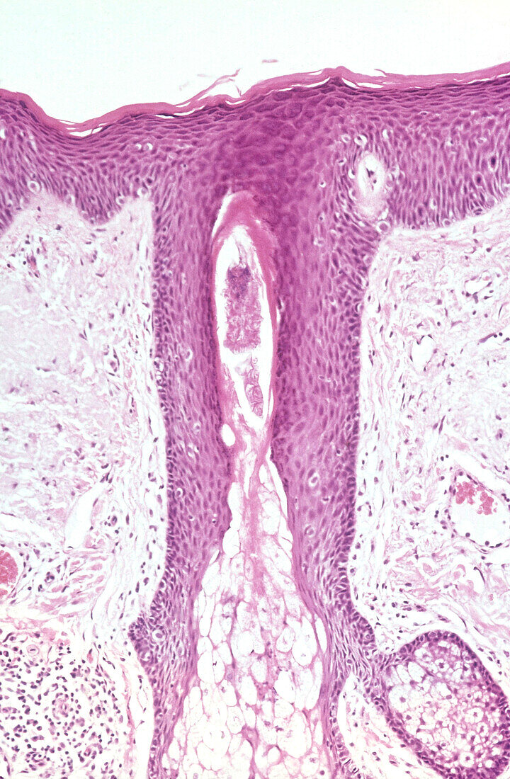 Hair follicle in rosacea, light micrograph