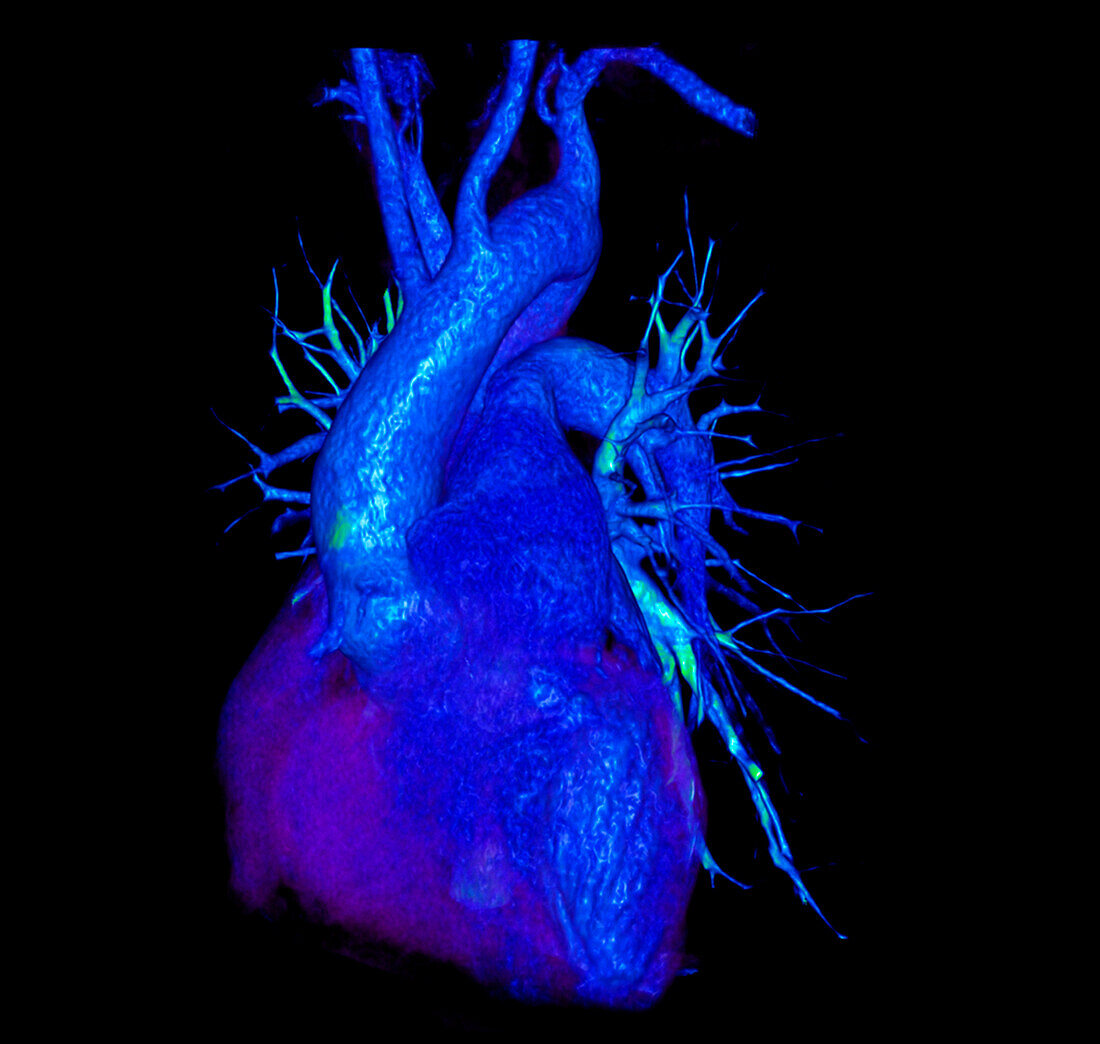 Kommerell diverticulum, 3D CT scan